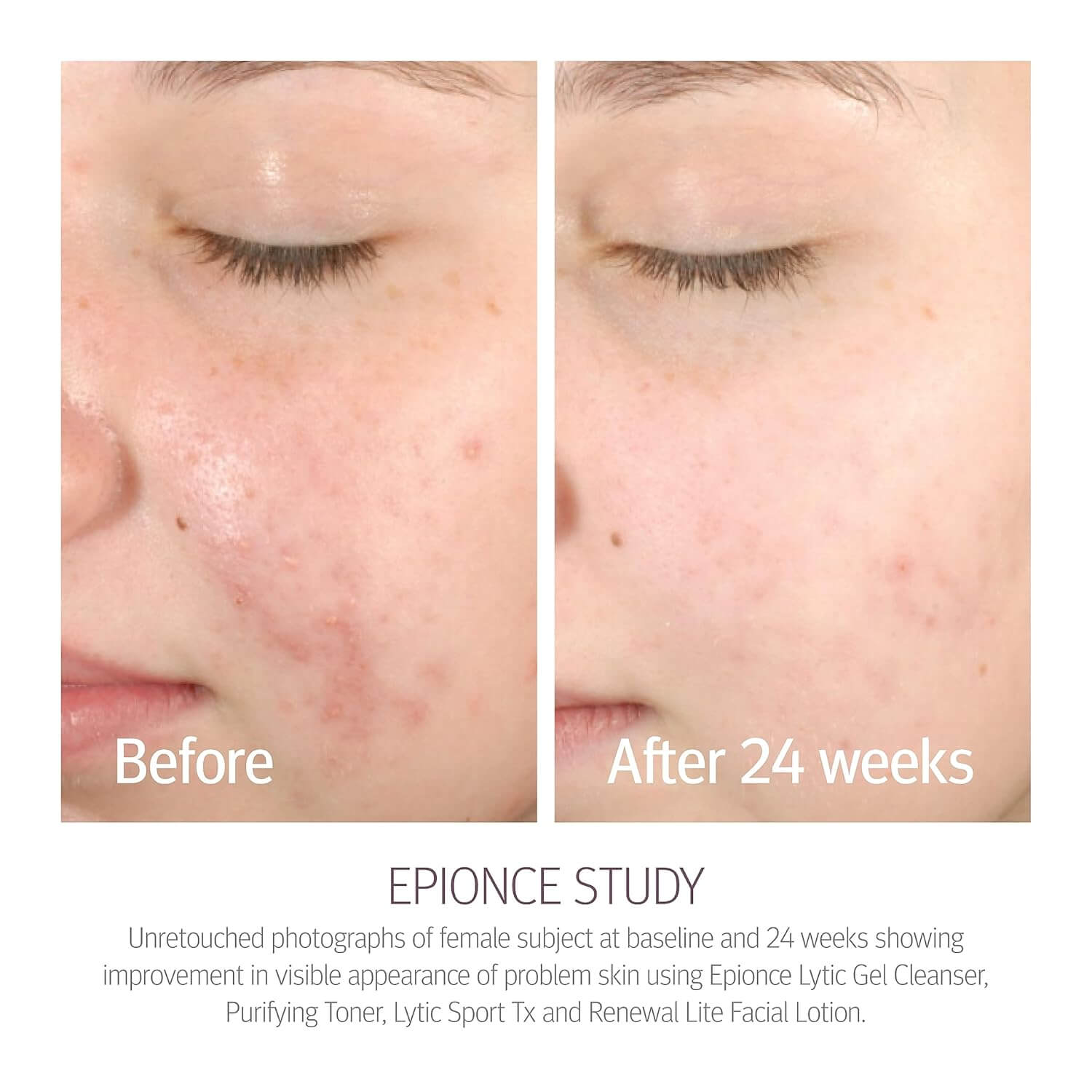 epionce-lytic-gel-cleanser-results-24wks.jpg