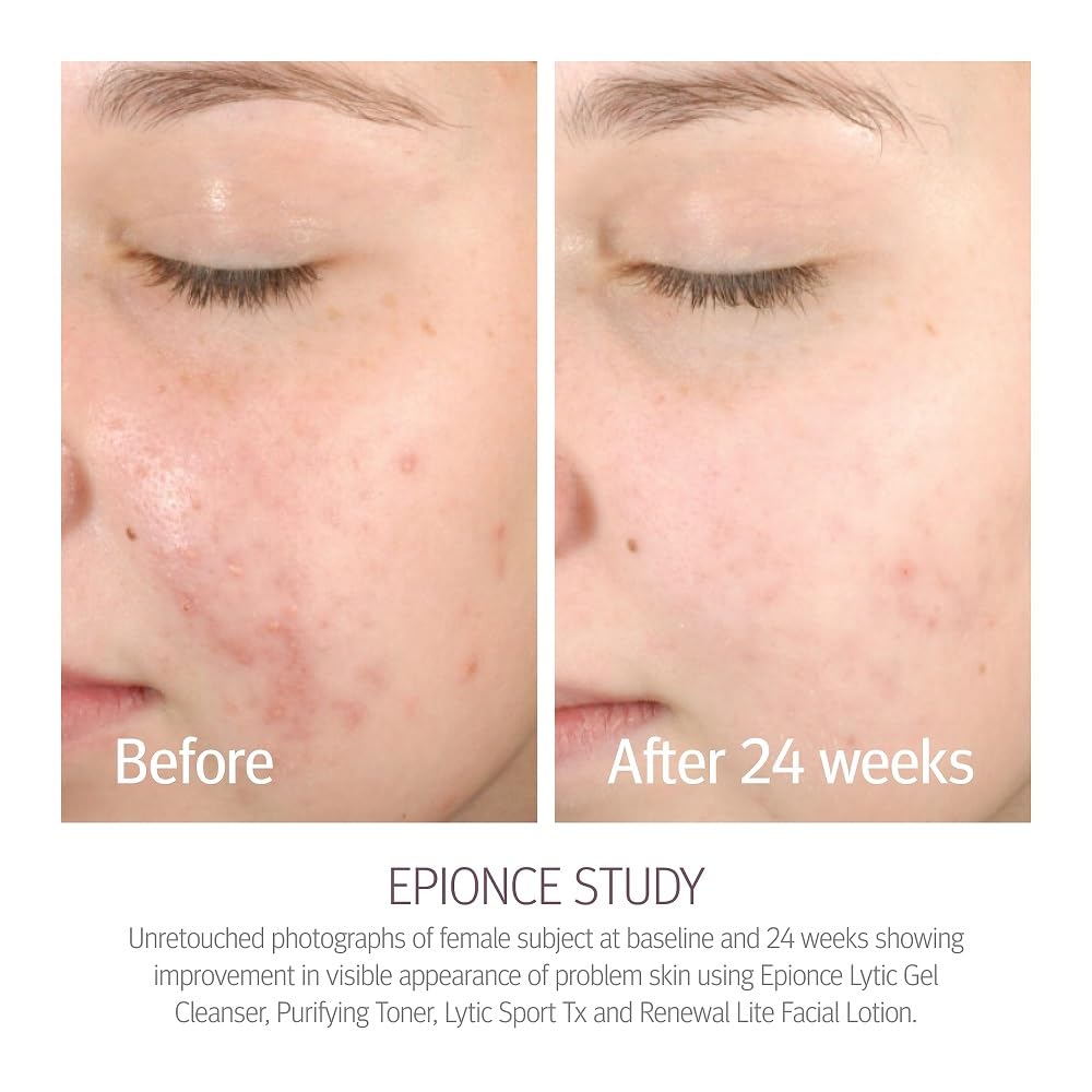 epionce-renewal-lite-facial-lotion-results-24wks.jpg