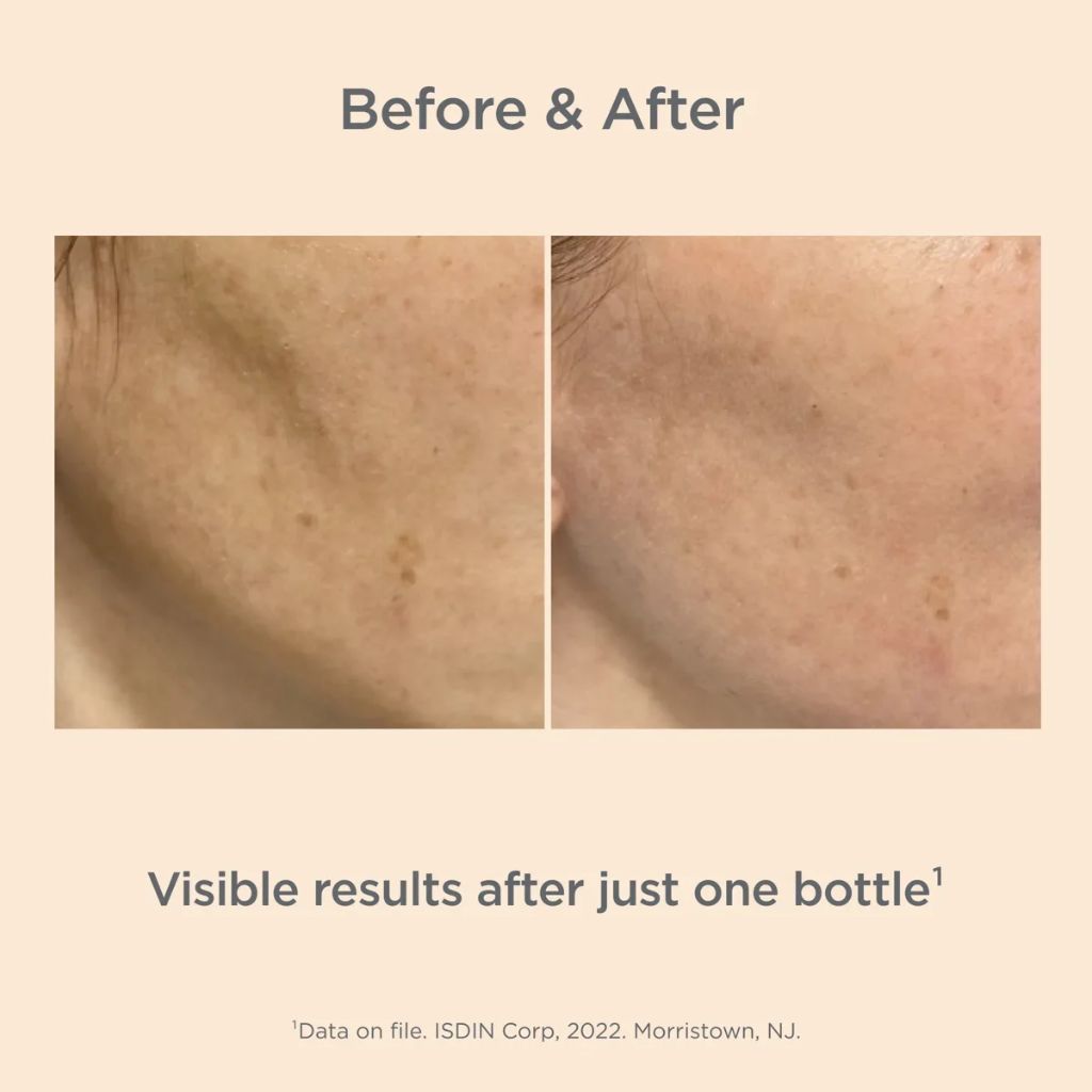 isdin-isdinceutics-melaclear-advanced-before-after.jpg