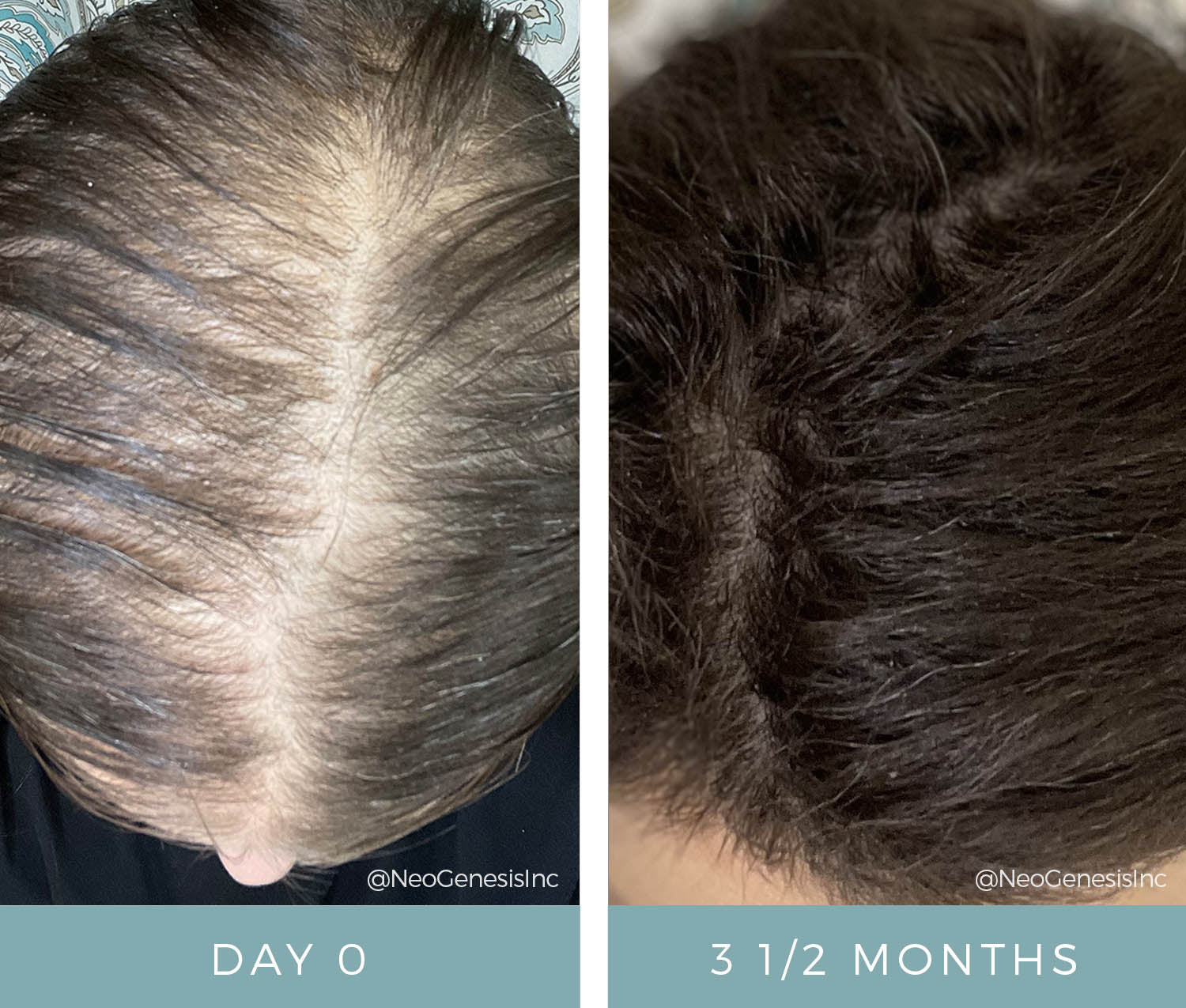 neogenesis-hair-thickening-serum-before-after-3.5mo-post-chemotherapy.jpg
