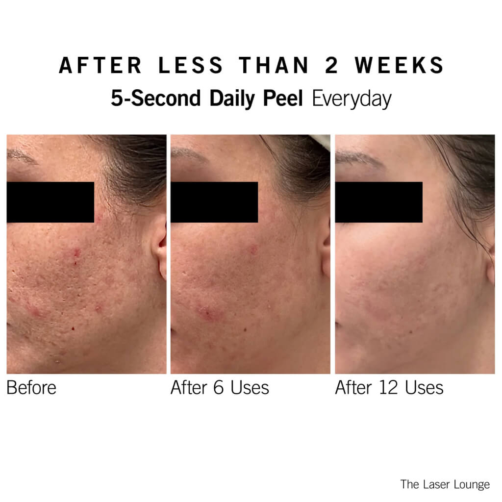 neova-5-second-daily-peel-results-6wk-12wk-1024px.jpg