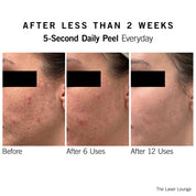 5-Second Daily Peel