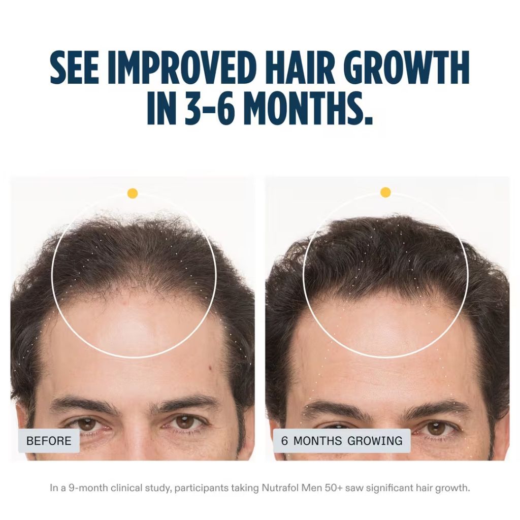 nutrafol men 50+ supplement before and after comparison of improved hair growth in 6 months
