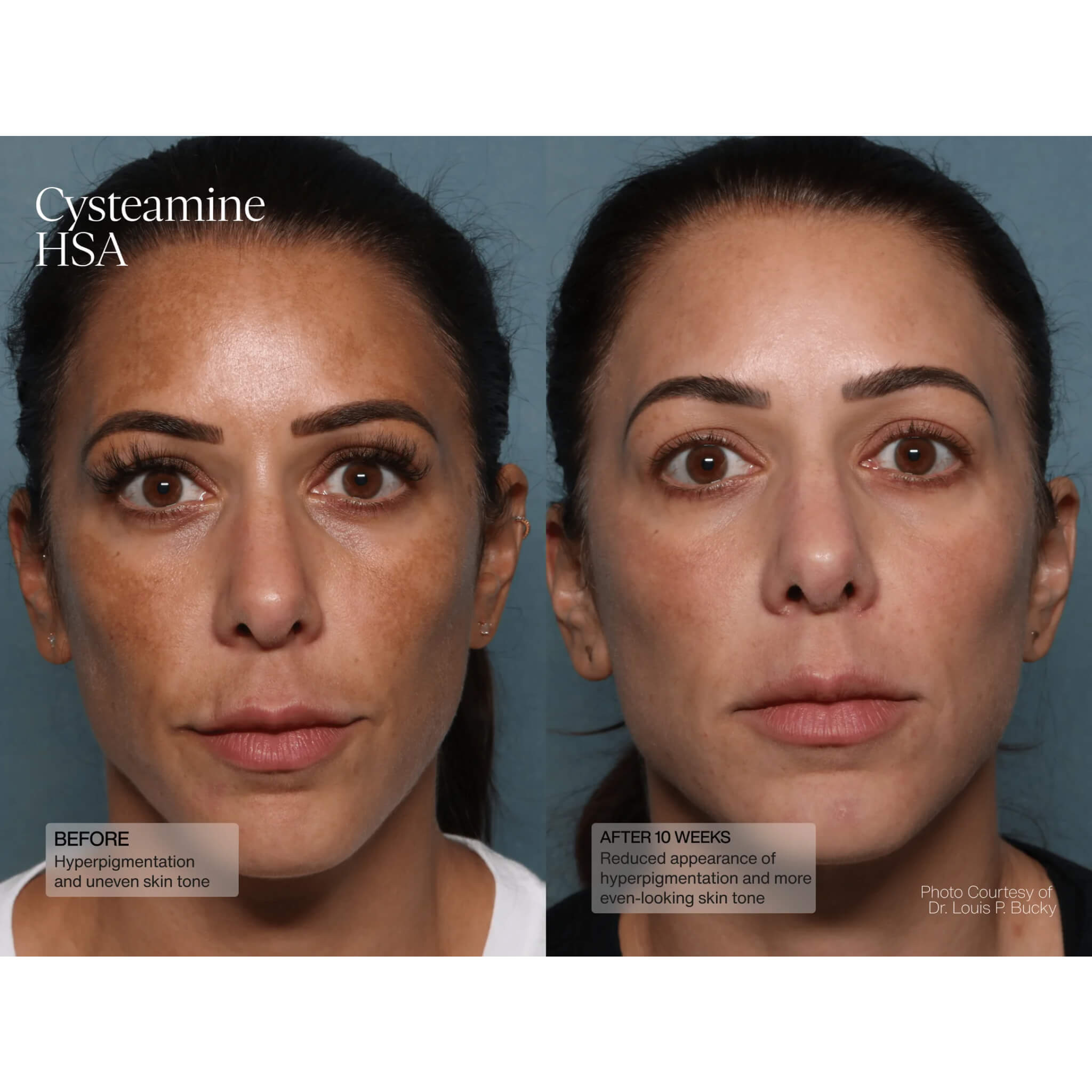Cysteamine HSA Pigment & Tone Corrector
