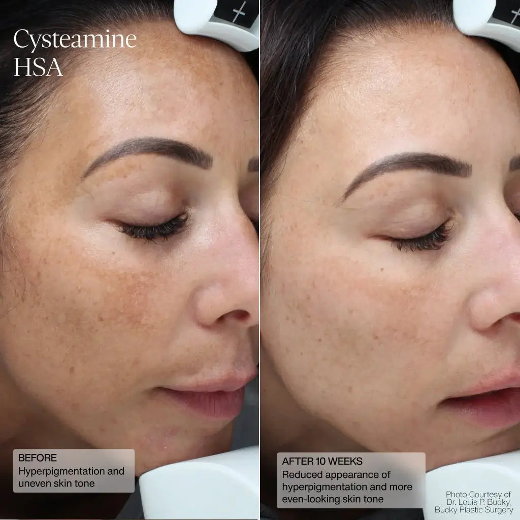 sente-cysteamine-hsa-pigment-tone-corrector-results-10wks.webp