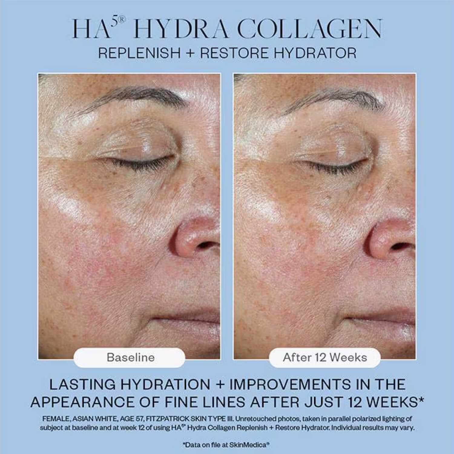 skinmedica-ha5-hydra-collagen-replenish-restore-hydrator-results-12wks.jpg